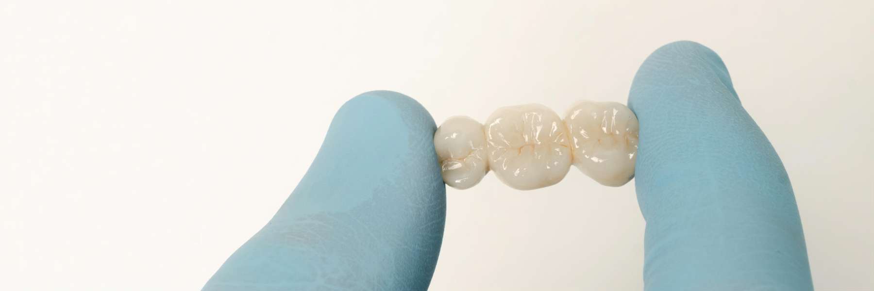 Crowns and Bridges | Dentist